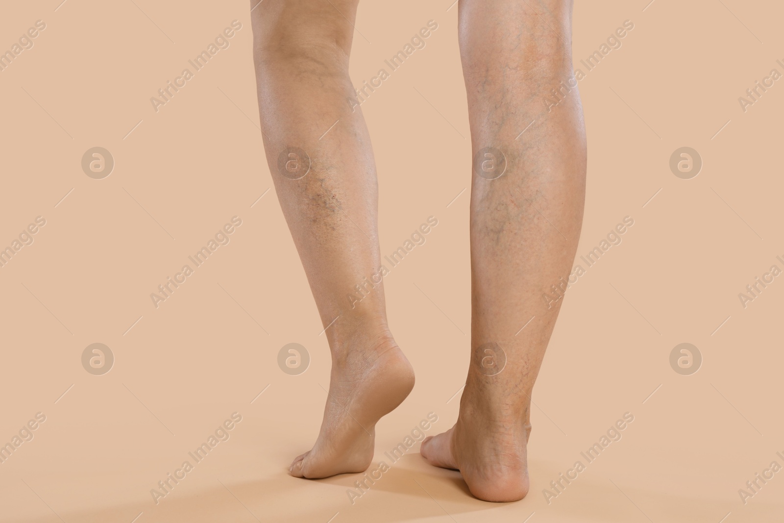 Photo of Woman with varicose veins on beige background, closeup