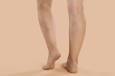 Woman with varicose veins on beige background, closeup