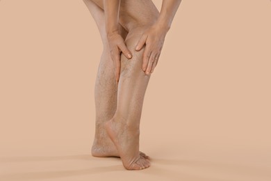 Photo of Woman suffering from varicose veins on beige background, closeup