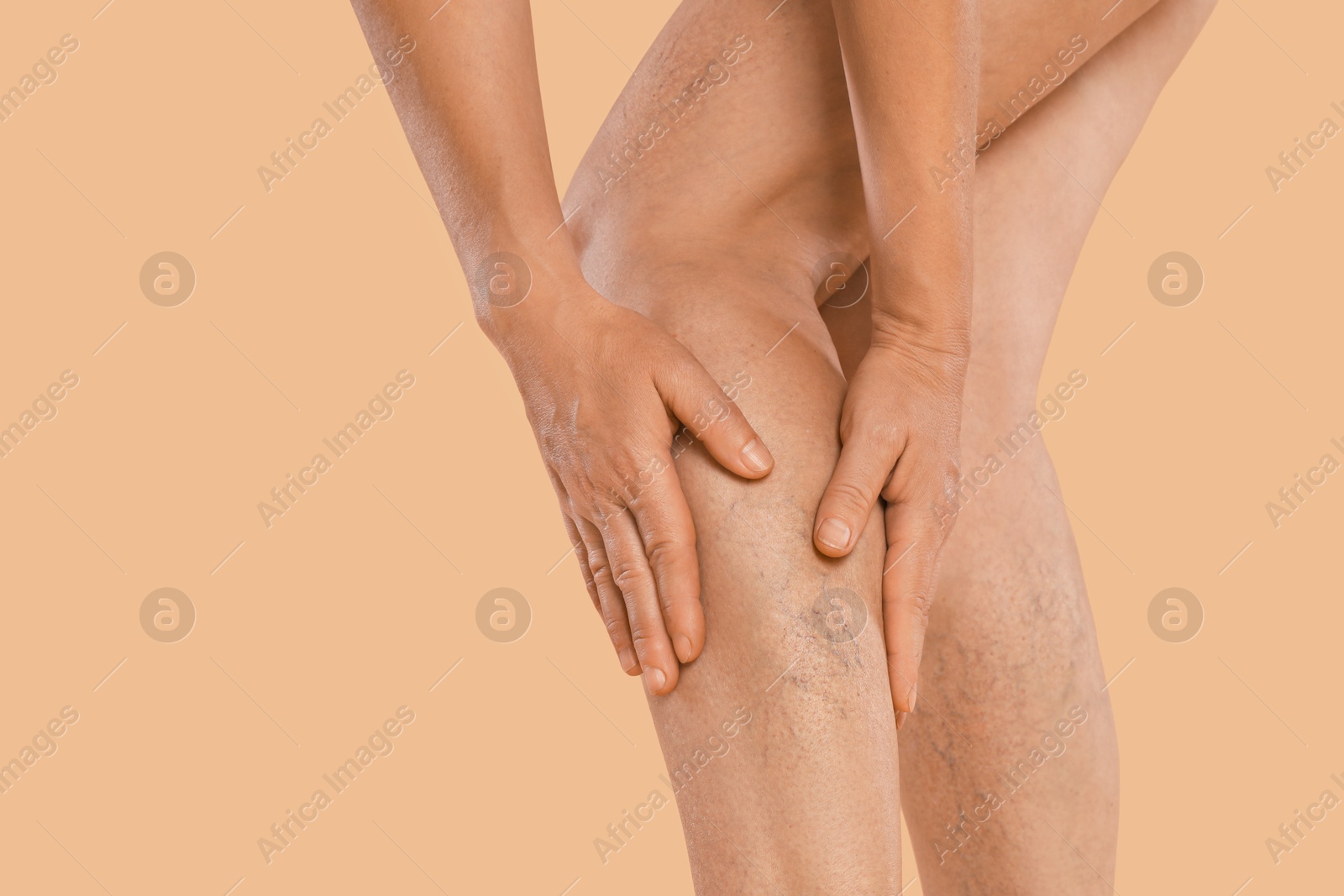 Photo of Woman suffering from varicose veins on beige background, closeup. Space for text