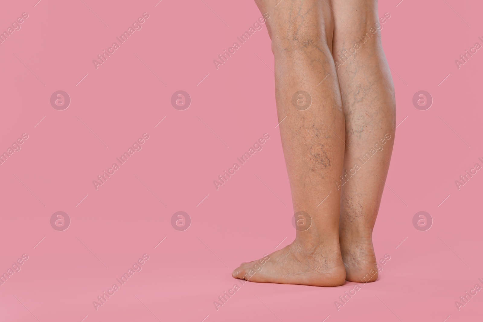 Photo of Woman with varicose veins on pink background, closeup. Space for text