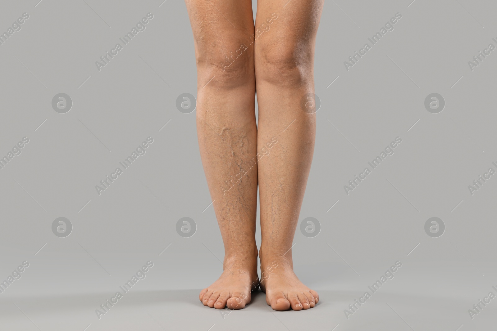 Photo of Woman with varicose veins on grey background, closeup