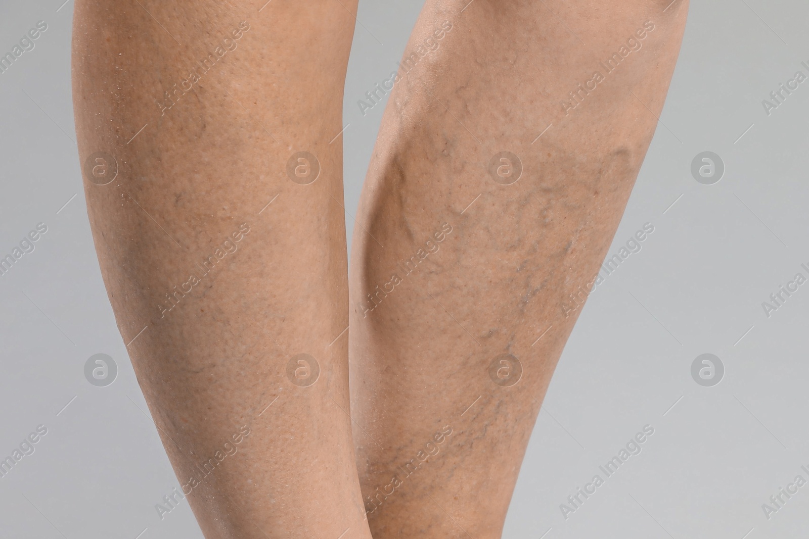 Photo of Woman with varicose veins on grey background, closeup