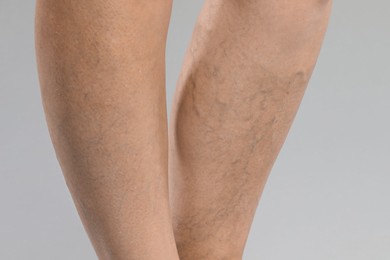 Woman with varicose veins on grey background, closeup