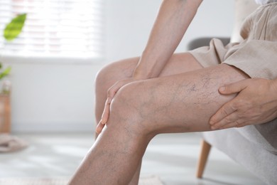 Photo of Woman suffering from varicose veins on sofa indoors, closeup