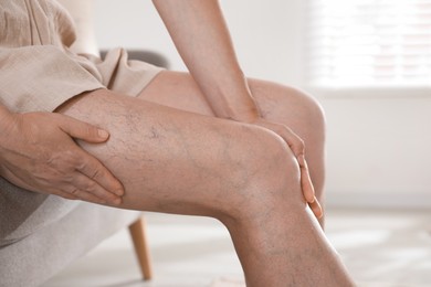 Photo of Woman suffering from varicose veins on sofa indoors, closeup