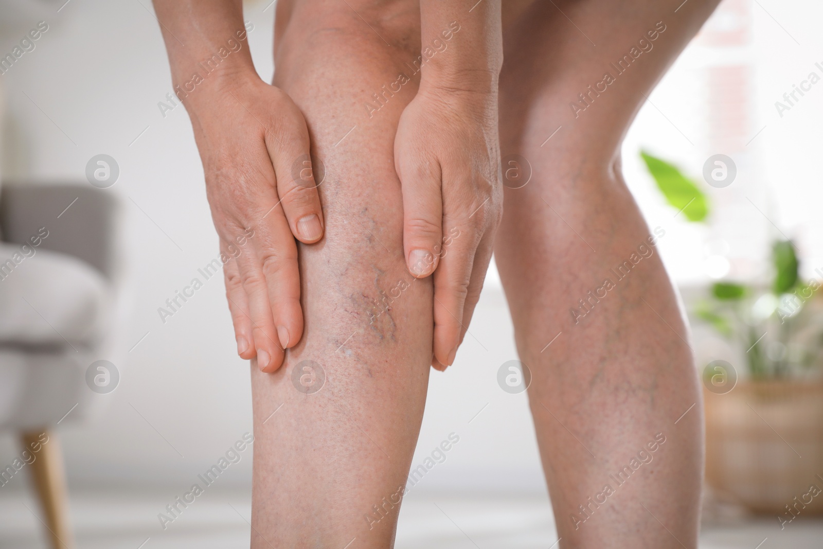 Photo of Woman suffering from varicose veins indoors, closeup