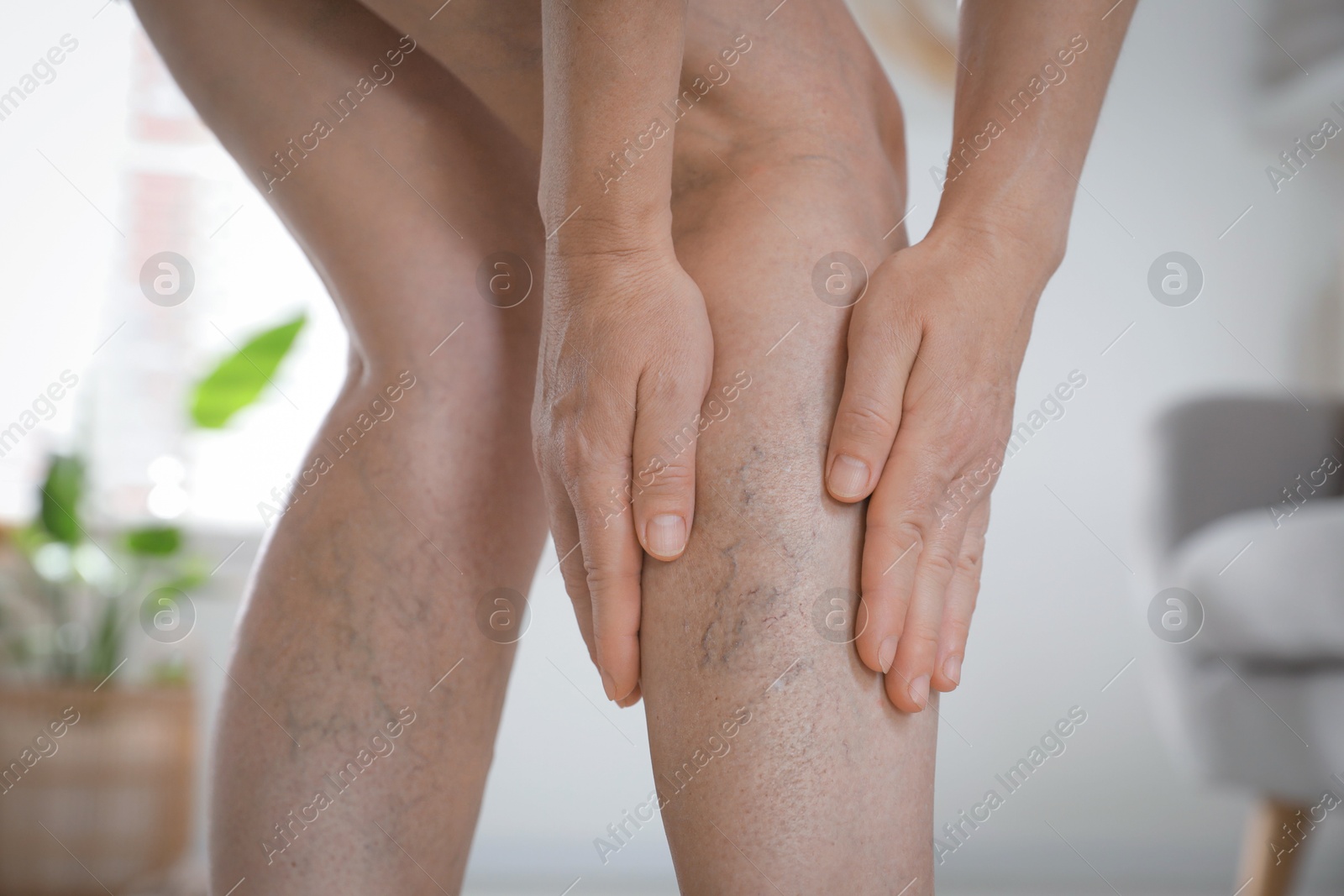 Photo of Woman suffering from varicose veins indoors, closeup