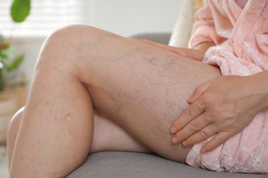 Photo of Woman suffering from varicose veins on sofa indoors, closeup