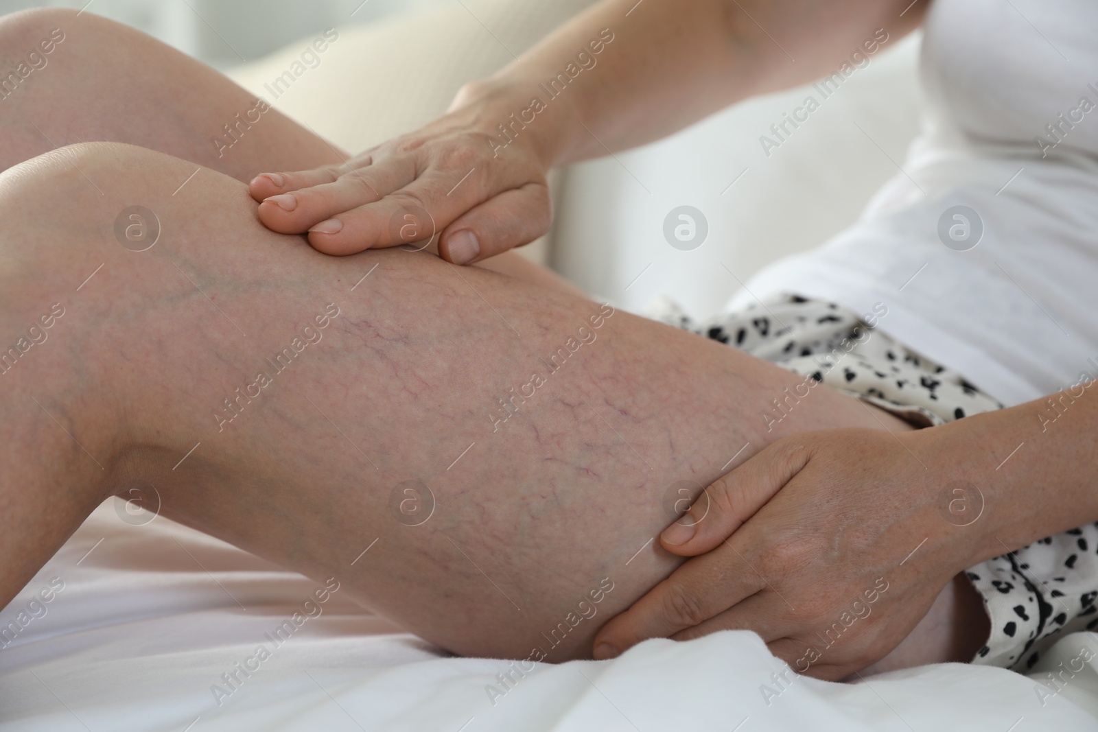 Photo of Woman suffering from varicose veins on bed indoors, closeup