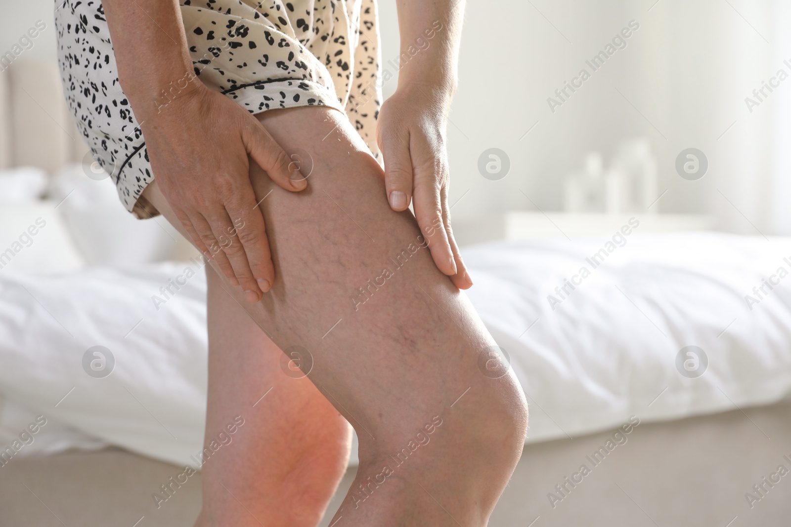 Photo of Woman suffering from varicose veins indoors, closeup. Space for text