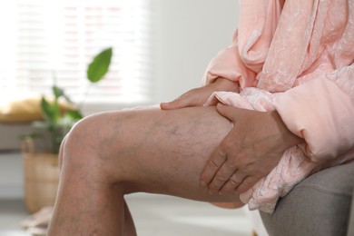 Photo of Woman suffering from varicose veins on sofa indoors, closeup