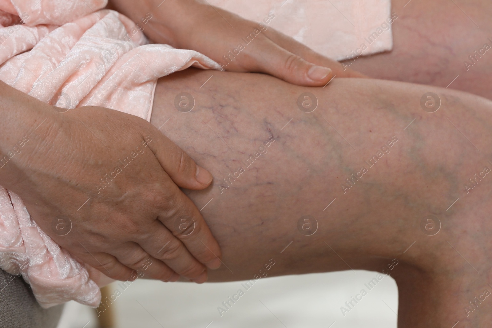 Photo of Woman suffering from varicose veins indoors, closeup