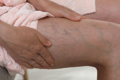 Photo of Woman suffering from varicose veins indoors, closeup