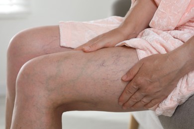 Photo of Woman suffering from varicose veins indoors, closeup