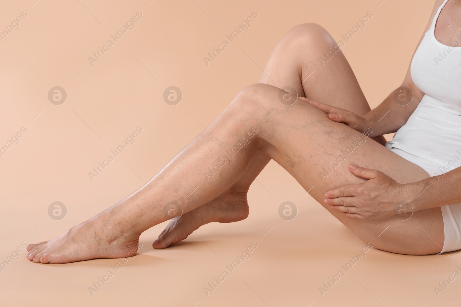 Photo of Woman suffering from varicose veins on beige background, closeup