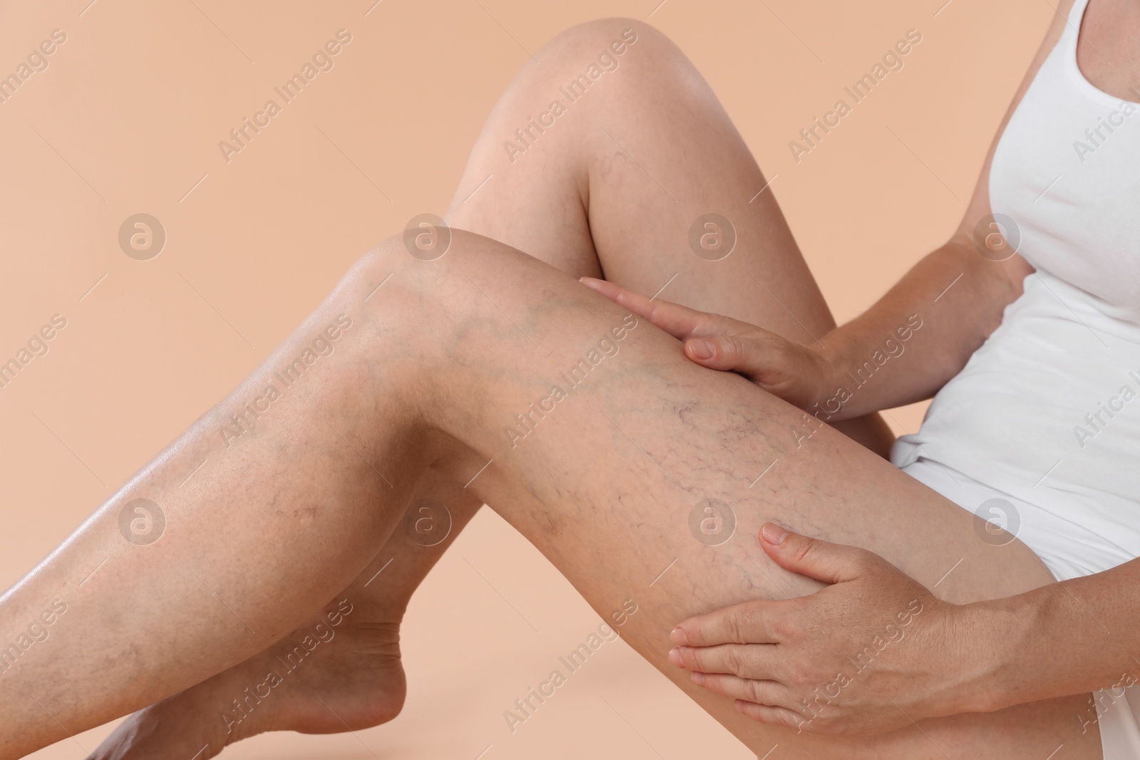 Photo of Woman suffering from varicose veins on beige background, closeup