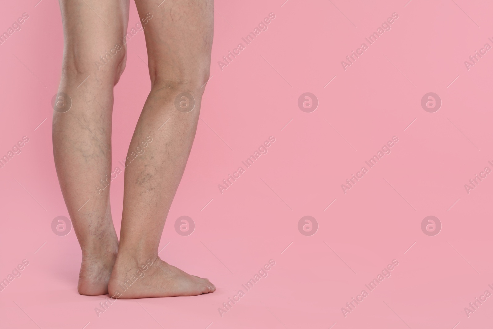 Photo of Woman with varicose veins on pink background, closeup. Space for text