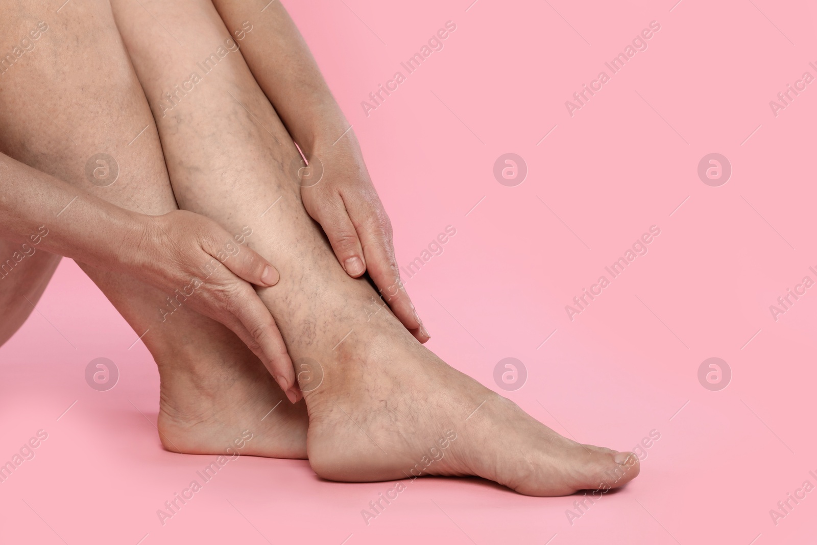 Photo of Woman suffering from varicose veins on pink background, closeup