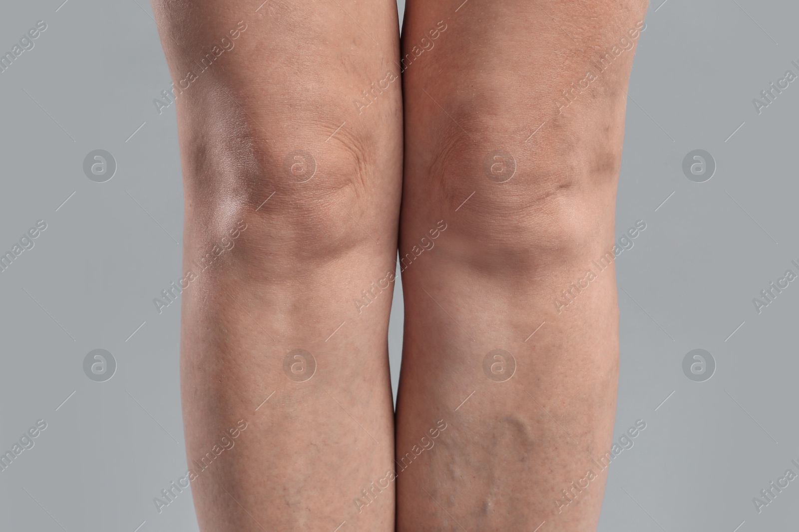 Photo of Woman with varicose veins on grey background, closeup