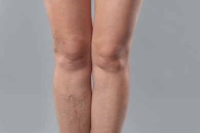 Photo of Woman with varicose veins on grey background, closeup