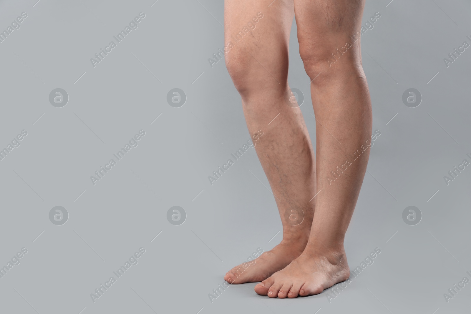 Photo of Woman with varicose veins on grey background, closeup. Space for text