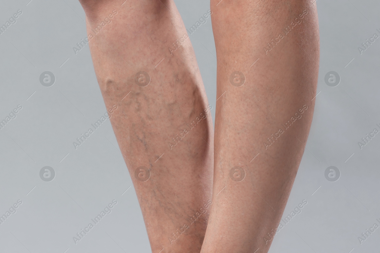 Photo of Woman with varicose veins on grey background, closeup