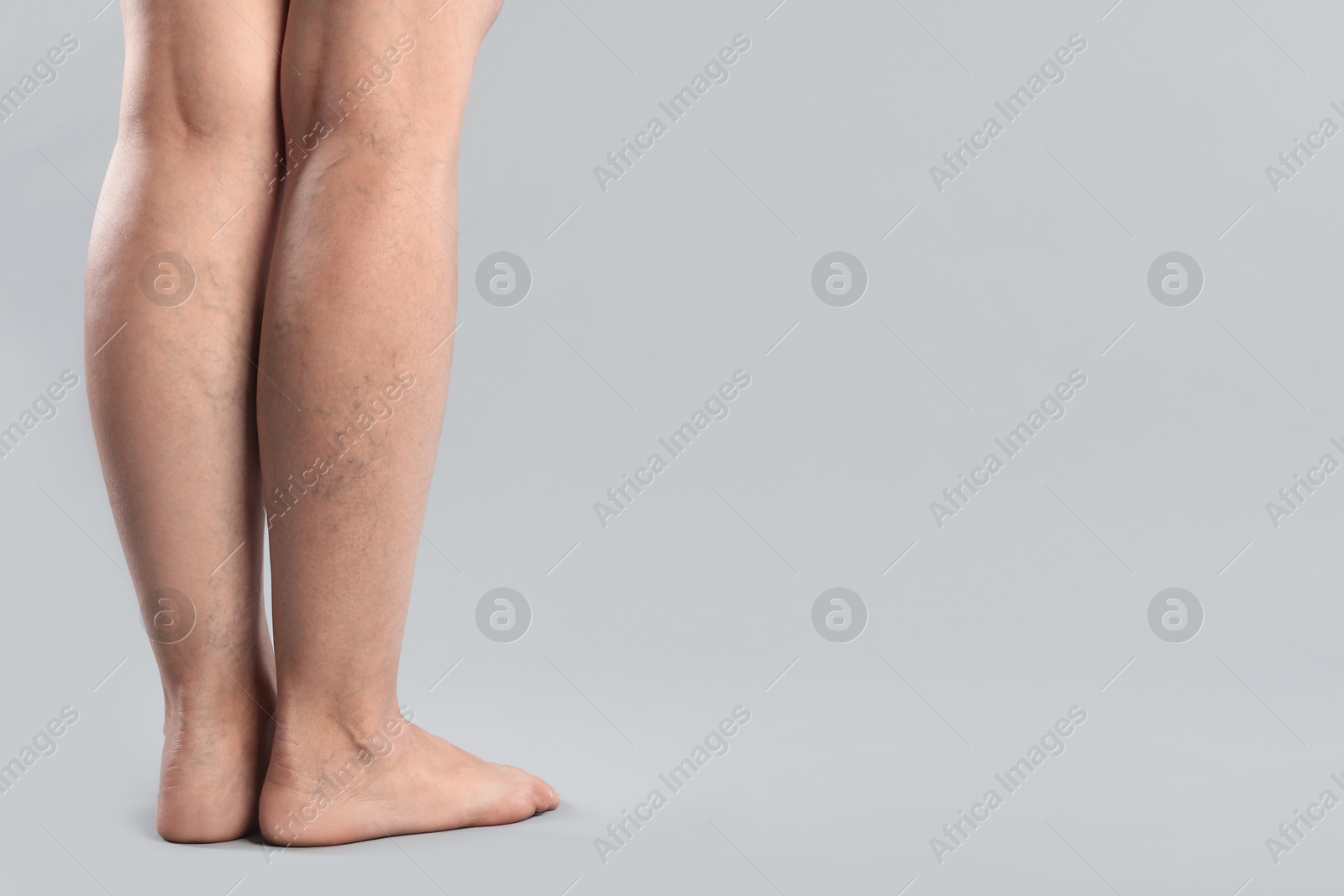 Photo of Woman with varicose veins on grey background, closeup. Space for text