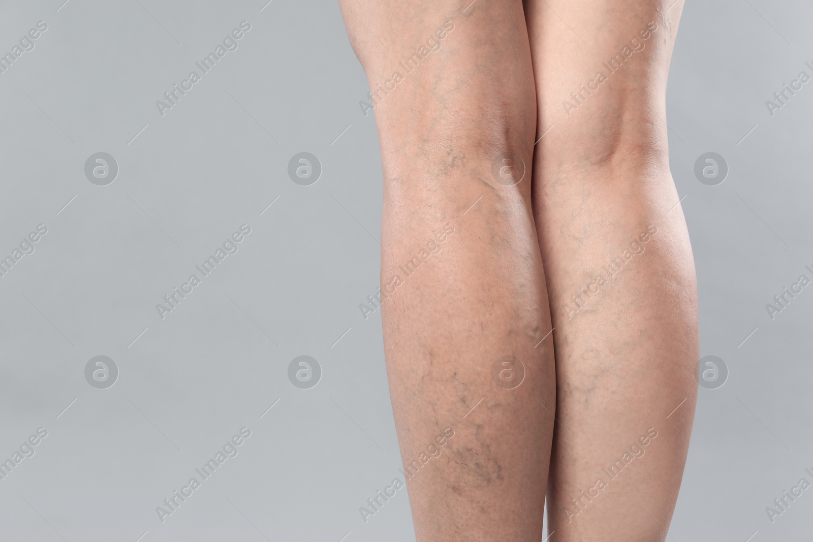 Photo of Woman with varicose veins on grey background, closeup. Space for text