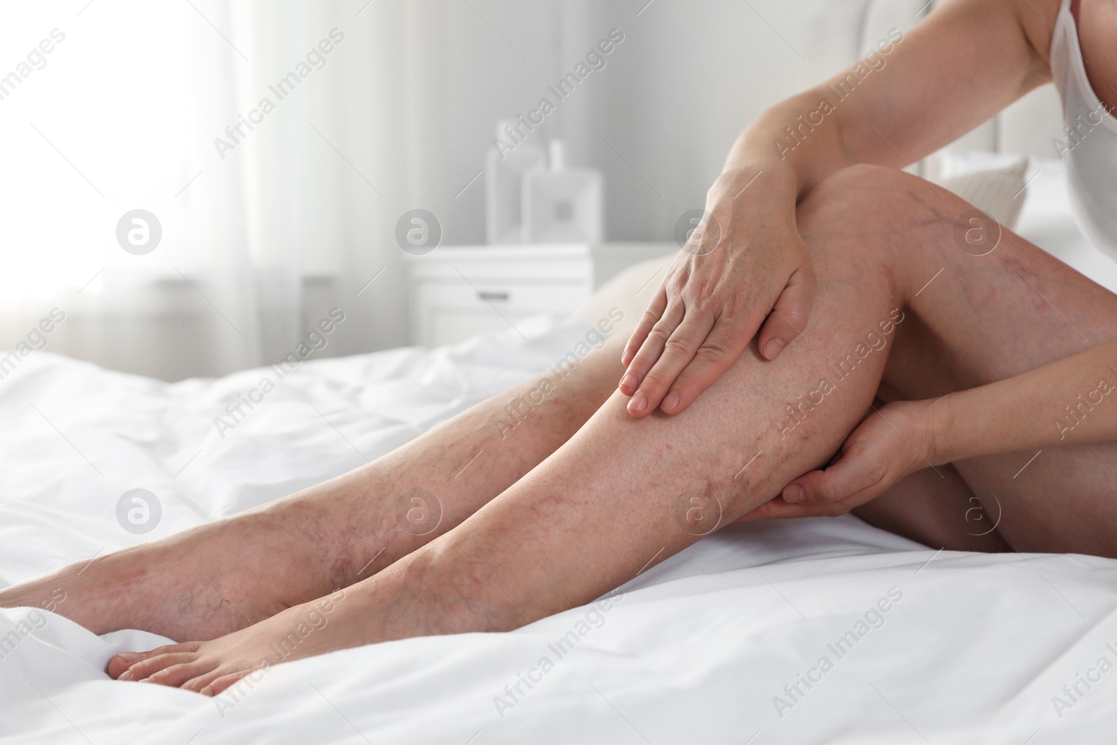 Photo of Woman suffering from varicose veins on bed indoors, closeup