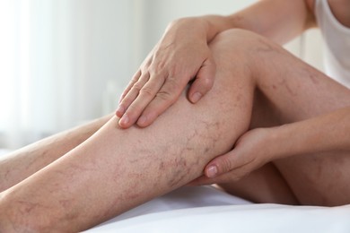 Photo of Woman suffering from varicose veins on bed indoors, closeup