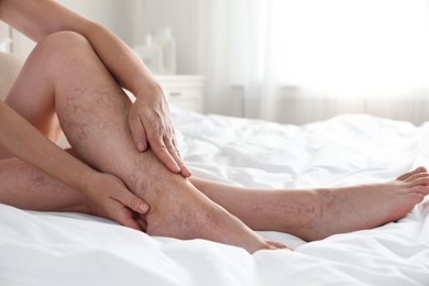 Photo of Woman suffering from varicose veins on bed indoors, closeup