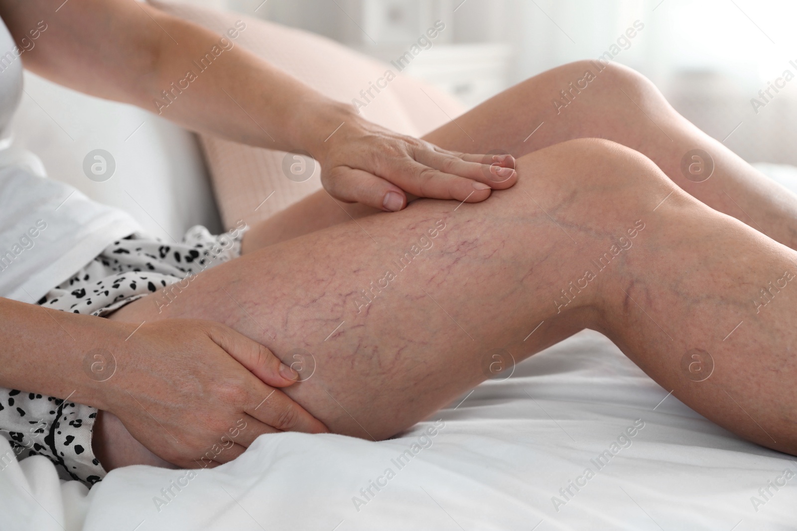 Photo of Woman suffering from varicose veins on bed indoors, closeup