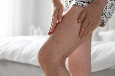 Photo of Woman suffering from varicose veins indoors, closeup