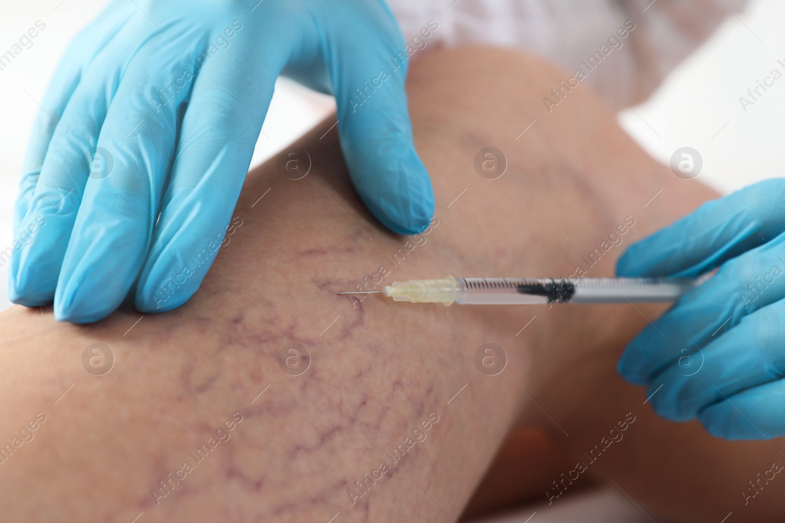 Photo of Varicose veins treatment. Doctor giving injection to patient indoors, closeup