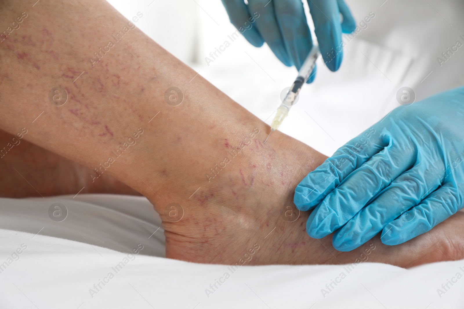 Photo of Varicose veins treatment. Doctor giving injection to patient indoors, closeup