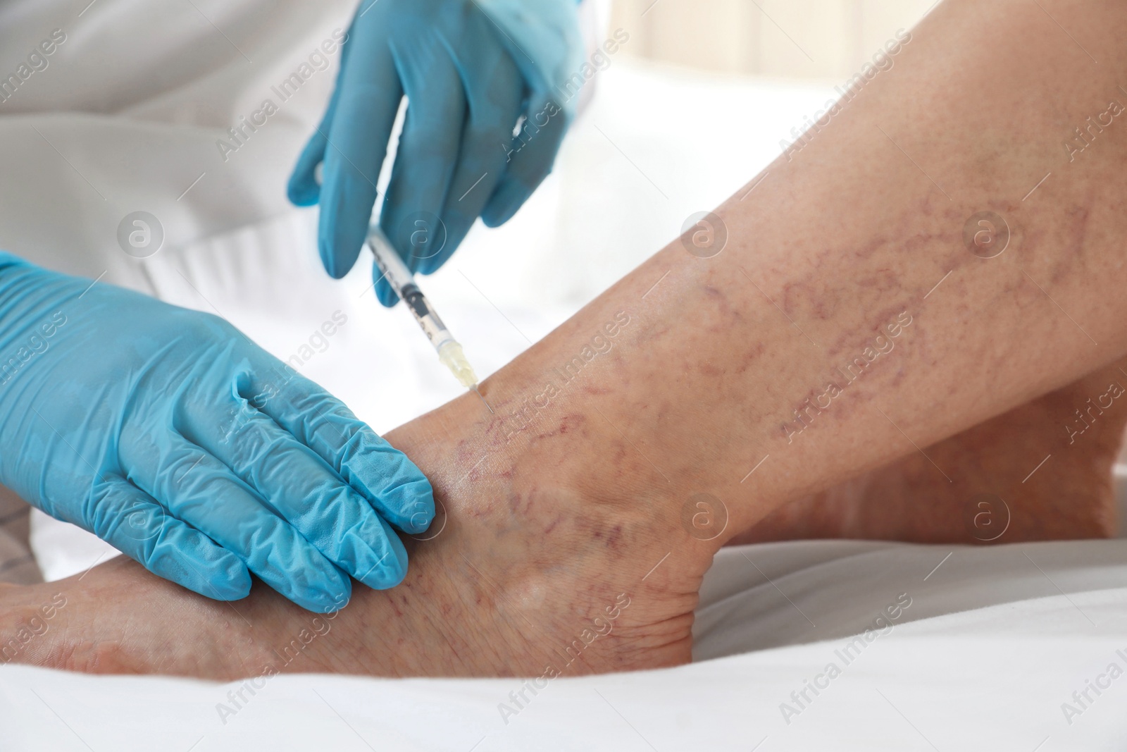 Photo of Varicose veins treatment. Doctor giving injection to patient indoors, closeup