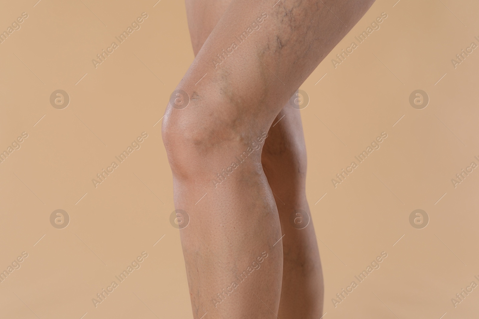 Photo of Woman with varicose veins on beige background, closeup