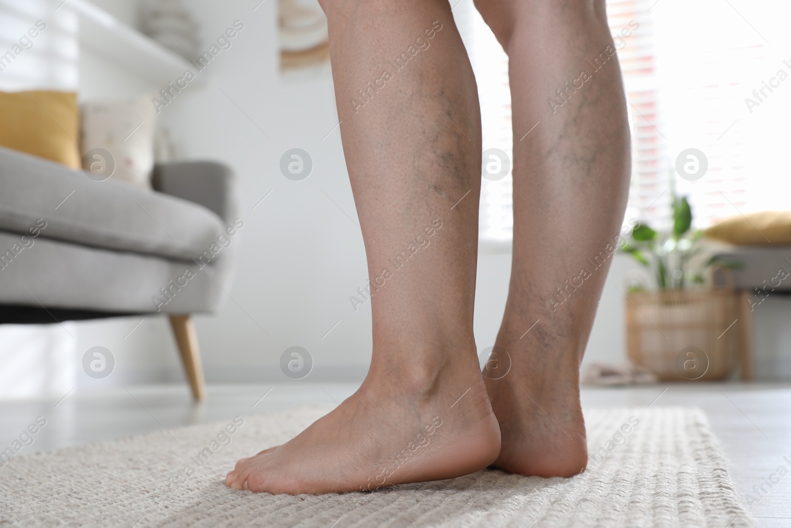 Photo of Woman suffering from varicose veins indoors, closeup