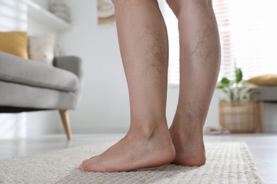 Woman suffering from varicose veins indoors, closeup