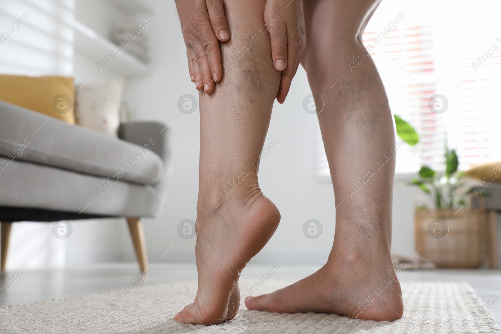 Photo of Woman suffering from varicose veins indoors, closeup