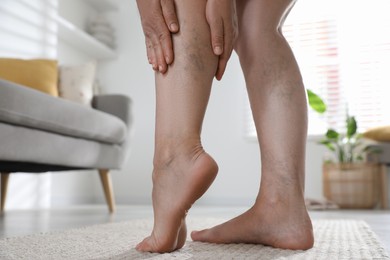 Photo of Woman suffering from varicose veins indoors, closeup