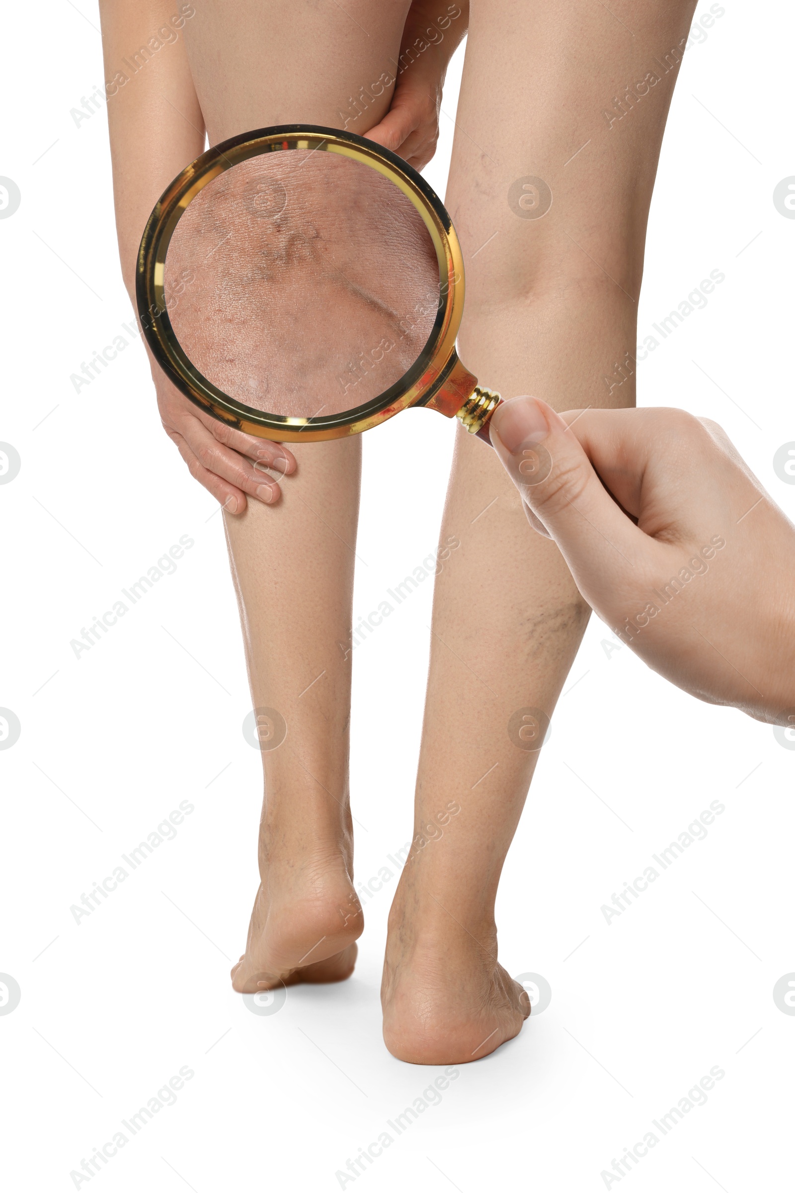 Image of Woman suffering from varicose veins on white background, closeup. Affected leg, zoomed view through magnifying glass