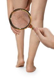 Woman suffering from varicose veins on white background, closeup. Affected leg, zoomed view through magnifying glass