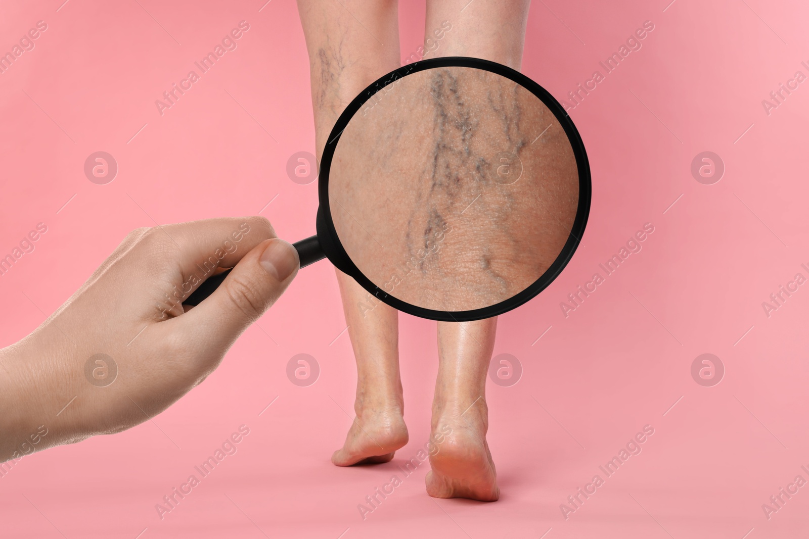 Image of Woman suffering from varicose veins on pink background, closeup. Affected leg, zoomed view through magnifying glass