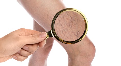 Woman suffering from varicose veins on white background, closeup. Affected leg, zoomed view through magnifying glass