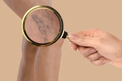 Woman suffering from varicose veins on dark beige background, closeup. Affected leg, zoomed view through magnifying glass