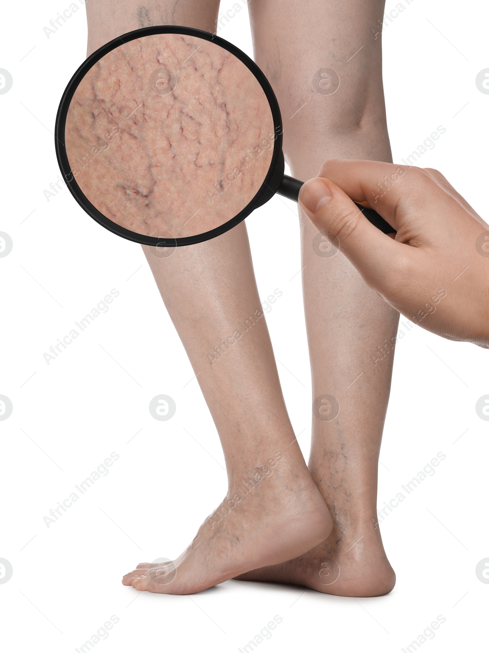 Image of Woman suffering from varicose veins on white background, closeup. Affected leg, zoomed view through magnifying glass