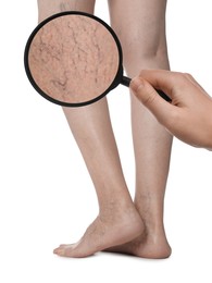 Woman suffering from varicose veins on white background, closeup. Affected leg, zoomed view through magnifying glass