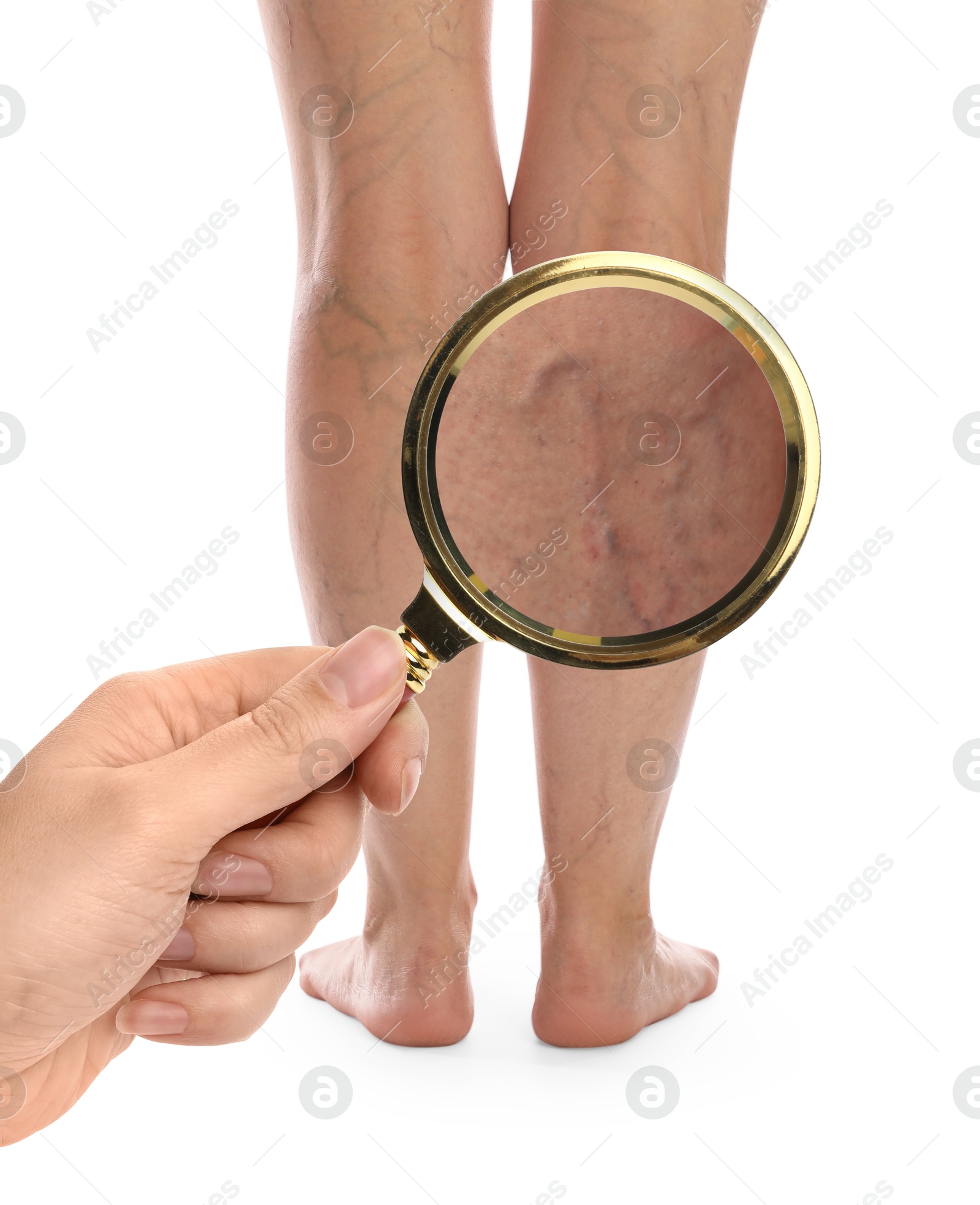 Image of Woman suffering from varicose veins on white background, closeup. Affected leg, zoomed view through magnifying glass